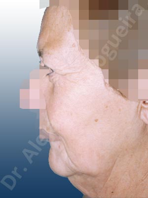 Baggy lower eyelids,Baggy upper eyelids,Deep nasolabial folds,Double chin flab,Droopy cheeks,Droopy eyebrows,Droopy face,Droopy forehead,Saggy jowls,Saggy neck,Saggy upper eyelids,Upper eyelids ptosis,Deep plane SMAS platysma face and neck lift,Lower eyelid fat bags resection,Short temporal incisions supraperiosteal extended lift of the upper two thirds of the face,Transconjunctival approach incision,Upper eyelid fat bags resection,Upper eyelid skin and muscle resection