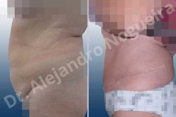 Saggy abdomen,Weak abdomen muscles,Standard abdominoplasty - photo 2