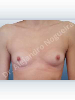 Asymmetric breasts,Empty breasts,Narrow breasts,Skinny breasts,Small breasts,Anatomical shape,Lower hemi periareolar incision,Subfascial pocket plane