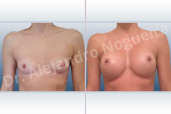 Asymmetric breasts,Empty breasts,Narrow breasts,Skinny breasts,Small breasts,Anatomical shape,Lower hemi periareolar incision,Subfascial pocket plane - photo 1