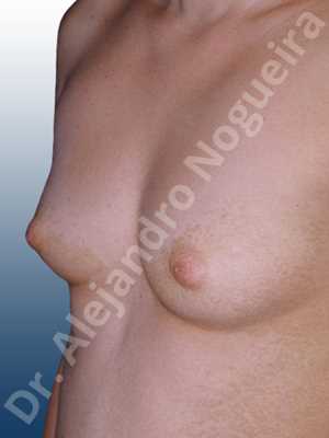 Narrow breasts,Small breasts,Sunken chest,Anatomical shape,Inframammary incision,Subfascial pocket plane