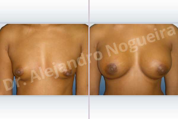 Asymmetric breasts,Cross eyed breasts,Narrow breasts,Small breasts,Tuberous breasts,Lower hemi periareolar incision,Round shape,Subfascial pocket plane,Tuberous mammoplasty - photo 1
