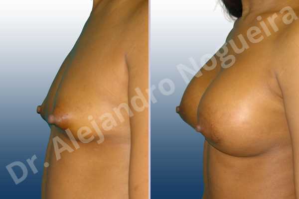 Asymmetric breasts,Cross eyed breasts,Narrow breasts,Small breasts,Tuberous breasts,Lower hemi periareolar incision,Round shape,Subfascial pocket plane,Tuberous mammoplasty - photo 2