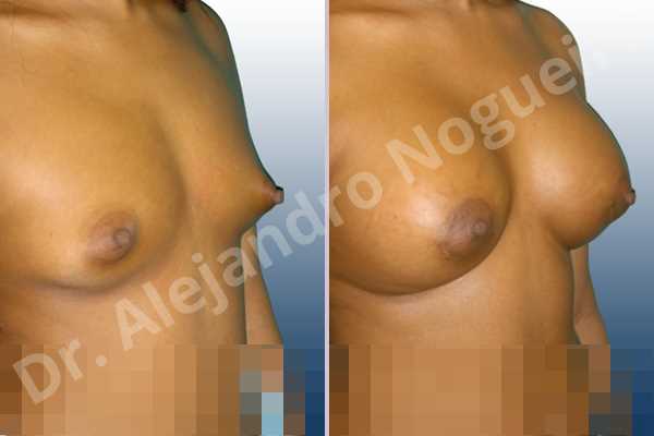 Asymmetric breasts,Cross eyed breasts,Narrow breasts,Small breasts,Tuberous breasts,Lower hemi periareolar incision,Round shape,Subfascial pocket plane,Tuberous mammoplasty - photo 5