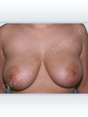 Asymmetric breasts,Breast tissue bottoming out,Large areolas,Lateral breasts,Moderately large breasts,Moderately saggy droopy breasts,Pendulous breasts,Severely large breasts,Severely saggy droopy breasts,Tuberous breasts,Wide breasts,Anchor incision,Areola reduction,Double vertical pedicle