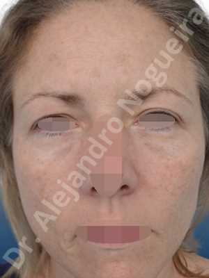 Deep nasolabial folds,Droopy cheeks,Droopy eyebrows,Droopy face,Droopy forehead,Saggy upper eyelids,Short temporal incisions supraperiosteal extended lift of the upper two thirds of the face,Upper eyelid skin and muscle resection