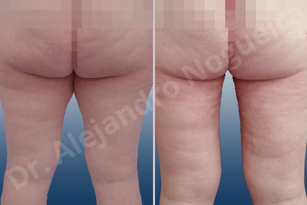 Thigh gap flab,Tumescent liposuction - photo 2