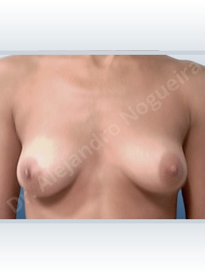 Cross eyed breasts,Empty breasts,Lateral breasts,Mildly saggy droopy breasts,Pigeon chest,Skinny breasts,Slightly saggy droopy breasts,Small breasts,Too far apart wide cleavage breasts,Anatomical shape,Lower hemi periareolar incision,Subfascial pocket plane