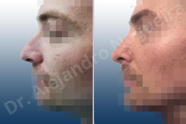 Alar flaring,Broad nose,Central European nose,Dorsum hump,Dorsum ridges,Droopy tip,Dynamic alar flaring,Jewish nose,Long upper lateral cartilages,Plunging tip deformity,Rhomboid dorsum,Thick skin nose,Closed approach incision,Dorsum hump resection,Lateral cruras cephalic resection,Medial cruras shortening resection,Nasal bones osteotomies,Triangular cartilages caudal resection - photo 2