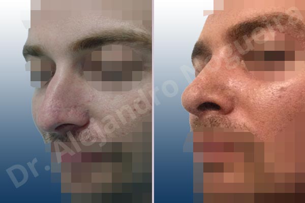 Alar flaring,Broad nose,Central European nose,Dorsum hump,Dorsum ridges,Droopy tip,Dynamic alar flaring,Jewish nose,Long upper lateral cartilages,Plunging tip deformity,Rhomboid dorsum,Thick skin nose,Closed approach incision,Dorsum hump resection,Lateral cruras cephalic resection,Medial cruras shortening resection,Nasal bones osteotomies,Triangular cartilages caudal resection - photo 3