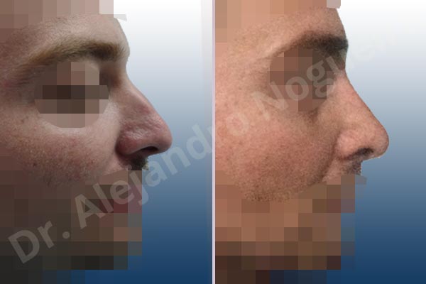 Alar flaring,Broad nose,Central European nose,Dorsum hump,Dorsum ridges,Droopy tip,Dynamic alar flaring,Jewish nose,Long upper lateral cartilages,Plunging tip deformity,Rhomboid dorsum,Thick skin nose,Closed approach incision,Dorsum hump resection,Lateral cruras cephalic resection,Medial cruras shortening resection,Nasal bones osteotomies,Triangular cartilages caudal resection - photo 4