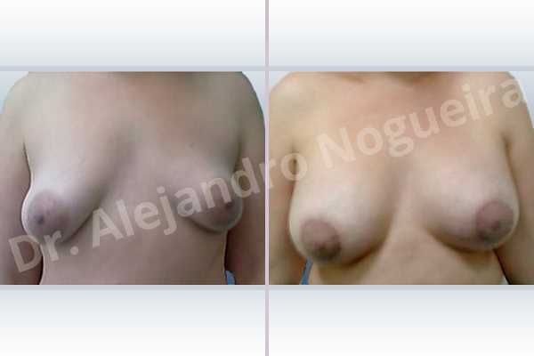 Asymmetric breasts,Empty breasts,Large areolas,Lateral breasts,Mildly saggy droopy breasts,Pigeon chest,Slightly saggy droopy breasts,Small breasts,Too far apart wide cleavage breasts,Tuberous breasts,Wide breasts,Anatomical shape,Areola reduction,Circumareolar incision,Subfascial pocket plane,Tuberous mammoplasty - photo 1
