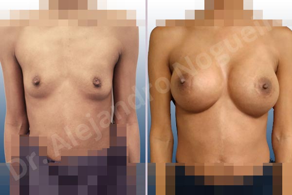 Asymmetric breasts,Empty breasts,Narrow breasts,Skinny breasts,Small breasts,Too far apart wide cleavage breasts,Anatomical shape,Extra large size,Lower hemi periareolar incision,Subfascial pocket plane - photo 1