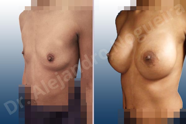 Asymmetric breasts,Empty breasts,Narrow breasts,Skinny breasts,Small breasts,Too far apart wide cleavage breasts,Anatomical shape,Extra large size,Lower hemi periareolar incision,Subfascial pocket plane - photo 3