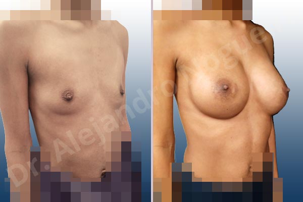 Asymmetric breasts,Empty breasts,Narrow breasts,Skinny breasts,Small breasts,Too far apart wide cleavage breasts,Anatomical shape,Extra large size,Lower hemi periareolar incision,Subfascial pocket plane - photo 5