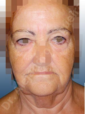 Baggy lower eyelids,Baggy upper eyelids,Deep nasolabial folds,Double chin flab,Droopy cheeks,Droopy face,Saggy jowls,Saggy neck,Saggy upper eyelids,Deep plane SMAS platysma face and neck lift,Lower eyelid fat bags resection,Transconjunctival approach incision,Upper eyelid fat bags resection,Upper eyelid skin and muscle resection