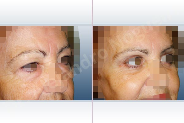 Baggy lower eyelids,Baggy upper eyelids,Deep nasolabial folds,Double chin flab,Droopy cheeks,Droopy face,Saggy jowls,Saggy neck,Saggy upper eyelids,Deep plane SMAS platysma face and neck lift,Lower eyelid fat bags resection,Transconjunctival approach incision,Upper eyelid fat bags resection,Upper eyelid skin and muscle resection - photo 10