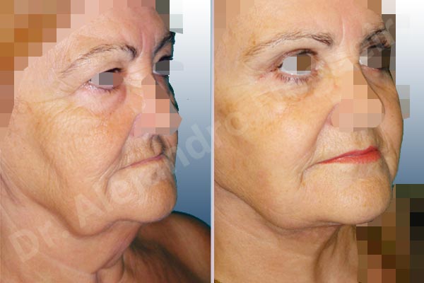 Baggy lower eyelids,Baggy upper eyelids,Deep nasolabial folds,Double chin flab,Droopy cheeks,Droopy face,Saggy jowls,Saggy neck,Saggy upper eyelids,Deep plane SMAS platysma face and neck lift,Lower eyelid fat bags resection,Transconjunctival approach incision,Upper eyelid fat bags resection,Upper eyelid skin and muscle resection - photo 5
