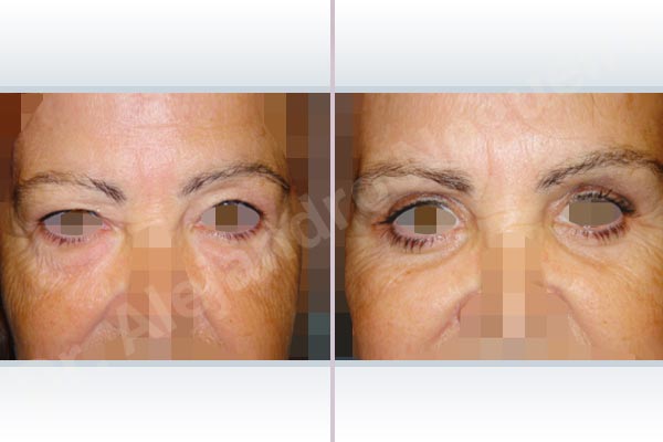 Baggy lower eyelids,Baggy upper eyelids,Deep nasolabial folds,Double chin flab,Droopy cheeks,Droopy face,Saggy jowls,Saggy neck,Saggy upper eyelids,Deep plane SMAS platysma face and neck lift,Lower eyelid fat bags resection,Transconjunctival approach incision,Upper eyelid fat bags resection,Upper eyelid skin and muscle resection - photo 6