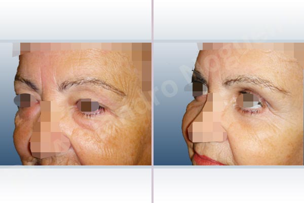 Baggy lower eyelids,Baggy upper eyelids,Deep nasolabial folds,Double chin flab,Droopy cheeks,Droopy face,Saggy jowls,Saggy neck,Saggy upper eyelids,Deep plane SMAS platysma face and neck lift,Lower eyelid fat bags resection,Transconjunctival approach incision,Upper eyelid fat bags resection,Upper eyelid skin and muscle resection - photo 8