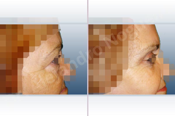 Baggy lower eyelids,Baggy upper eyelids,Deep nasolabial folds,Double chin flab,Droopy cheeks,Droopy face,Saggy jowls,Saggy neck,Saggy upper eyelids,Deep plane SMAS platysma face and neck lift,Lower eyelid fat bags resection,Transconjunctival approach incision,Upper eyelid fat bags resection,Upper eyelid skin and muscle resection - photo 9