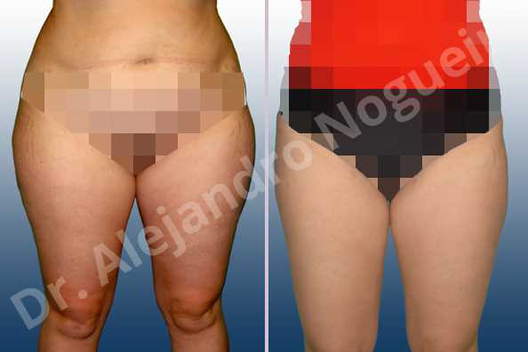 Saddle bags flab,Thigh gap flab,Tumescent liposuction - photo 1