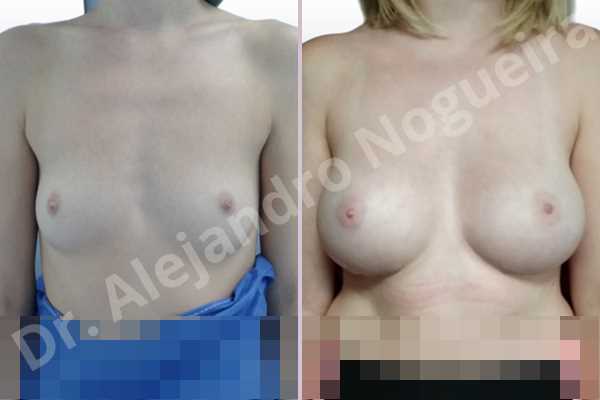 Asymmetric breasts,Cross eyed breasts,Empty breasts,Lateral breasts,Skinny breasts,Small breasts,Too far apart wide cleavage breasts,Wide breasts,Anatomical shape,Inframammary incision,Subfascial pocket plane - photo 1