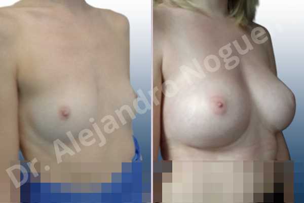 Asymmetric breasts,Cross eyed breasts,Empty breasts,Lateral breasts,Skinny breasts,Small breasts,Too far apart wide cleavage breasts,Wide breasts,Anatomical shape,Inframammary incision,Subfascial pocket plane - photo 5