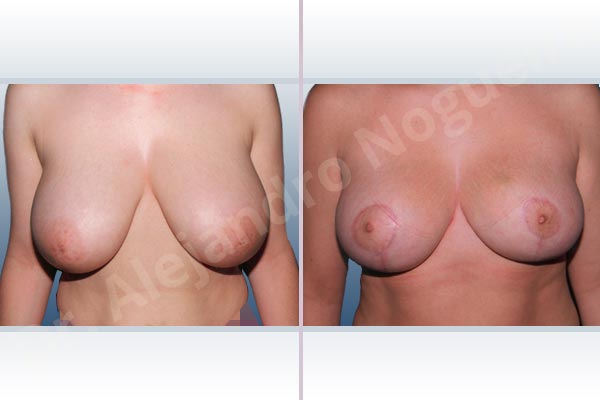 Breast tissues symmastia uniboob,Moderately large breasts,Severely saggy droopy breasts,Tuberous breasts,Anchor incision,Superior pedicle - photo 1