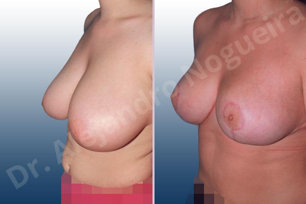 Breast tissues symmastia uniboob,Moderately large breasts,Severely saggy droopy breasts,Tuberous breasts,Anchor incision,Superior pedicle - photo 2