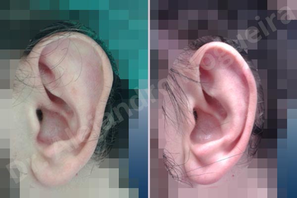 Large ears,Prominent ears,Fleur de lis cephalic ear resection - photo 3