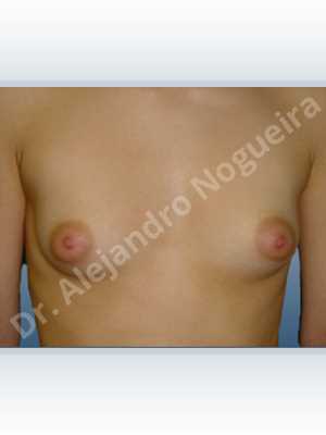 Asymmetric breasts,Cross eyed breasts,Lateral breasts,Small breasts,Too far apart wide cleavage breasts,Tuberous breasts,Lower hemi periareolar incision,Round shape,Subfascial pocket plane,Tuberous mammoplasty