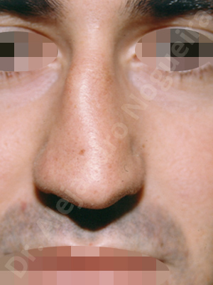 Asymmetric nose,Asymmetric tip,Crooked nose,Crooked septum,Crooked tip,Dorsum hump,Droopy tip,Irregular dorsum,Large alar cartilages,Large nose,Long nose,Long septum,Long upper lateral cartilages,Mediterranean nose,Nasal airway obstruction,Plunging tip deformity,Poorly supported tip,Posttraumatic nose,Thick skin nose,Caudal septum resection,Closed approach incision,Dorsum hump resection,Dorsum regularization,Lateral cruras cephalic resection,Nasal bones osteotomies,Septum bone realignment,Septum bone resection,Septum cartilage realignment,Septum cartilage resection,Triangular cartilages caudal resection