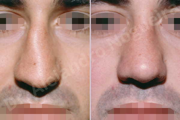 Asymmetric nose,Asymmetric tip,Crooked nose,Crooked septum,Crooked tip,Dorsum hump,Droopy tip,Irregular dorsum,Large alar cartilages,Large nose,Long nose,Long septum,Long upper lateral cartilages,Mediterranean nose,Nasal airway obstruction,Plunging tip deformity,Poorly supported tip,Posttraumatic nose,Thick skin nose,Caudal septum resection,Closed approach incision,Dorsum hump resection,Dorsum regularization,Lateral cruras cephalic resection,Nasal bones osteotomies,Septum bone realignment,Septum bone resection,Septum cartilage realignment,Septum cartilage resection,Triangular cartilages caudal resection - photo 1