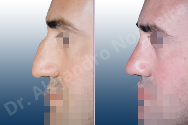 Asymmetric nose,Asymmetric tip,Crooked nose,Crooked septum,Crooked tip,Dorsum hump,Droopy tip,Irregular dorsum,Large alar cartilages,Large nose,Long nose,Long septum,Long upper lateral cartilages,Mediterranean nose,Nasal airway obstruction,Plunging tip deformity,Poorly supported tip,Posttraumatic nose,Thick skin nose,Caudal septum resection,Closed approach incision,Dorsum hump resection,Dorsum regularization,Lateral cruras cephalic resection,Nasal bones osteotomies,Septum bone realignment,Septum bone resection,Septum cartilage realignment,Septum cartilage resection,Triangular cartilages caudal resection - photo 2