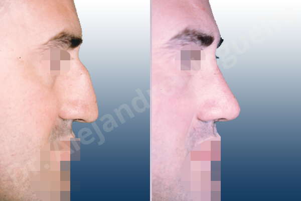 Asymmetric nose,Asymmetric tip,Crooked nose,Crooked septum,Crooked tip,Dorsum hump,Droopy tip,Irregular dorsum,Large alar cartilages,Large nose,Long nose,Long septum,Long upper lateral cartilages,Mediterranean nose,Nasal airway obstruction,Plunging tip deformity,Poorly supported tip,Posttraumatic nose,Thick skin nose,Caudal septum resection,Closed approach incision,Dorsum hump resection,Dorsum regularization,Lateral cruras cephalic resection,Nasal bones osteotomies,Septum bone realignment,Septum bone resection,Septum cartilage realignment,Septum cartilage resection,Triangular cartilages caudal resection - photo 3