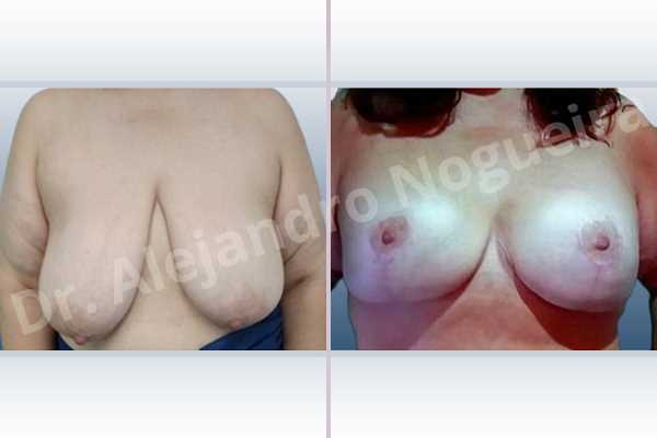 Asymmetric breasts,Breast tissue bottoming out,Breast tissues symmastia uniboob,Empty breasts,Extremely saggy droopy breasts,Large areolas,Pendulous breasts,Severely large breasts,Too far apart wide cleavage breasts,Wide breasts,Tuberous breasts,Anatomical shape,Anchor incision,Areola reduction,Double vertical pedicle,Subfascial pocket plane - photo 1