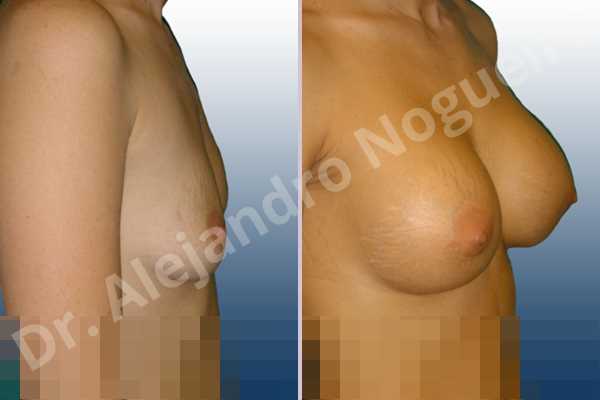 Asymmetric breasts,Empty breasts,Lateral breasts,Mildly saggy droopy breasts,Skinny breasts,Slightly saggy droopy breasts,Small breasts,Sunken chest,Too far apart wide cleavage breasts,Lower hemi periareolar incision,Round shape,Subfascial pocket plane - photo 4