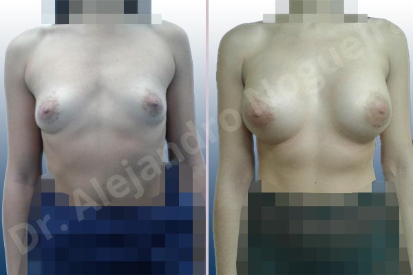 Large areolas,Lateral breasts,Pigeon chest,Skinny breasts,Small breasts,Too far apart wide cleavage breasts,Anatomical shape,Lower hemi periareolar incision,Subfascial pocket plane - photo 1