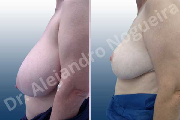Asymmetric breasts,Breast tissue bottoming out,Extremely large breasts,Extremely saggy droopy breasts,Large areolas,Lateral breasts,Pendulous breasts,Pigeon chest,Wide breasts,Tuberous breasts,Anchor incision,Areola reduction,Double vertical pedicle - photo 2