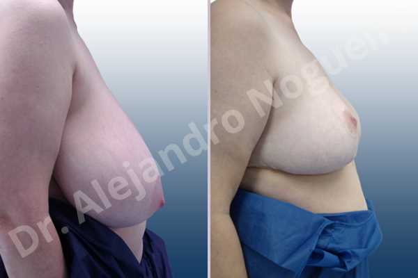 Asymmetric breasts,Breast tissue bottoming out,Extremely large breasts,Extremely saggy droopy breasts,Large areolas,Lateral breasts,Pendulous breasts,Pigeon chest,Wide breasts,Tuberous breasts,Anchor incision,Areola reduction,Double vertical pedicle - photo 4