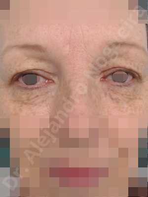 Baggy upper eyelids,Saggy upper eyelids,Upper eyelids ptosis,Upper eyelid fat bags resection,Upper eyelid skin and muscle resection