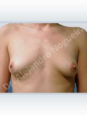 Lateral breasts,Narrow breasts,Skinny breasts,Small breasts,Sunken chest,Too far apart wide cleavage breasts,Tuberous breasts,Anatomical shape,Lower hemi periareolar incision,Subfascial pocket plane,Tuberous mammoplasty