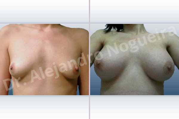 Lateral breasts,Narrow breasts,Skinny breasts,Small breasts,Sunken chest,Too far apart wide cleavage breasts,Tuberous breasts,Anatomical shape,Lower hemi periareolar incision,Subfascial pocket plane,Tuberous mammoplasty - photo 1