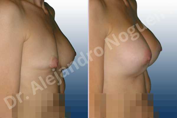 Asymmetric breasts,Breast implants animation muscle flex deformity,Breast implants capsular contracture,Breast tissue necrosis,Empty breasts,Skinny breasts,Slightly saggy droopy breasts,Small breasts,Sunken scars,Too far apart wide cleavage breasts,Anatomical shape,Capsulectomy,Excisional scar revision,Lower hemi periareolar incision,Subfascial pocket plane - photo 4