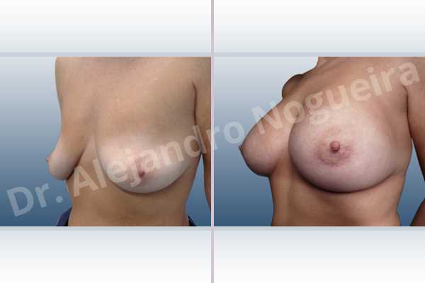Asymmetric breasts,Cross eyed breasts,Empty breasts,Lateral breasts,Moderately saggy droopy breasts,Pendulous breasts,Pigeon chest,Skinny breasts,Small breasts,Too far apart wide cleavage breasts,Wide breasts,Anatomical shape,Extra large size,Lower hemi periareolar incision,Subfascial pocket plane - photo 3