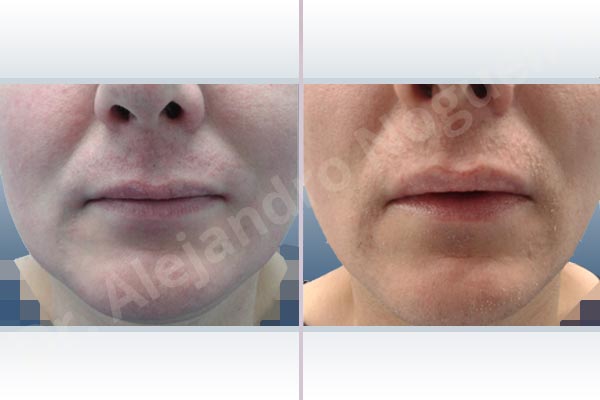 Small lips,Transgender lips,Lower lip autologous dermis collagen filler - photo 1