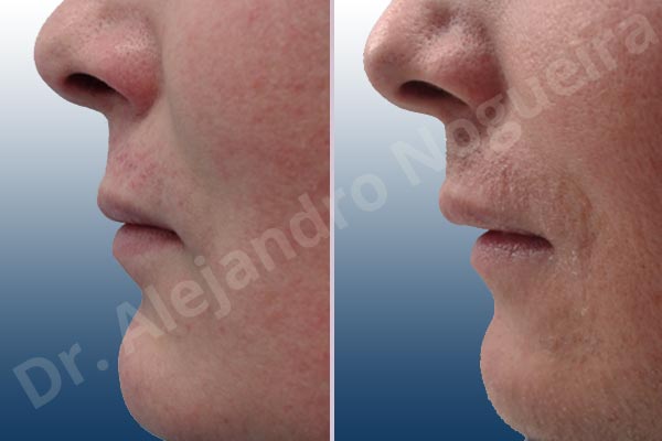 Small lips,Transgender lips,Lower lip autologous dermis collagen filler - photo 2