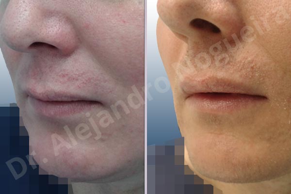 Small lips,Transgender lips,Lower lip autologous dermis collagen filler - photo 3