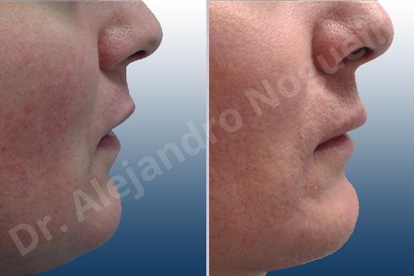 Small lips,Transgender lips,Lower lip autologous dermis collagen filler - photo 4